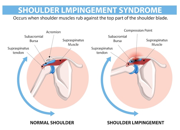 Gratis vector illustratie van het syndroom van schouderimpingement