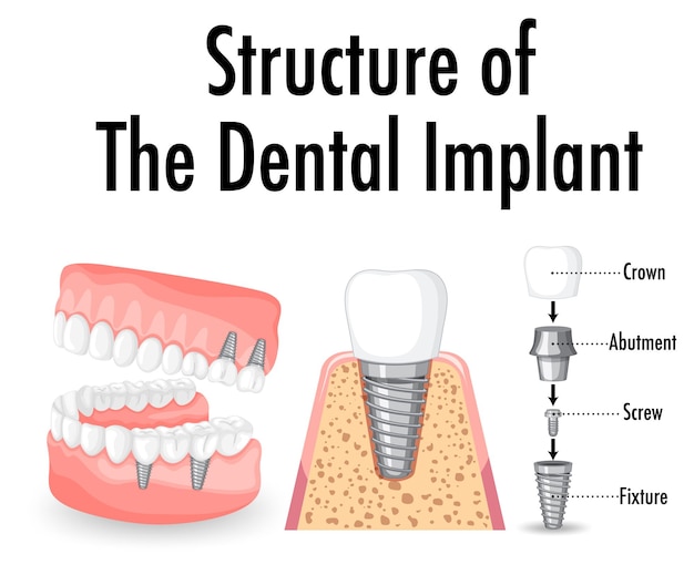 Infographic van de mens in de structuur van het tandheelkundig implantaat