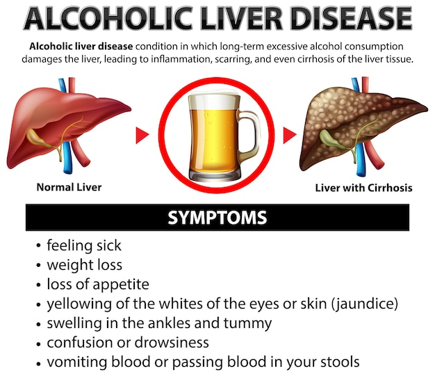 Informatieve poster van alcoholische leverziekte cirrose