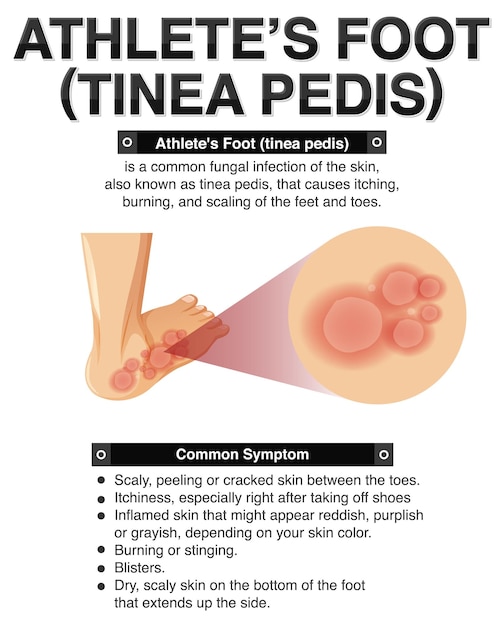 Informatieve poster van atleetvoet