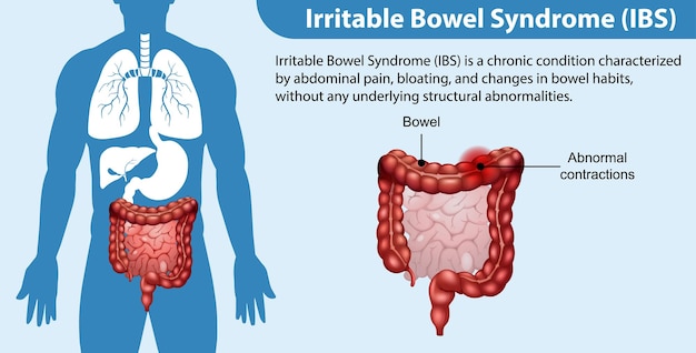 Gratis vector irritable bowel syndrome pds infographic