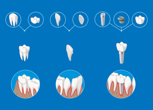 Isometrische prothetische tandheelkunde infographic sjabloon met kroonfineer