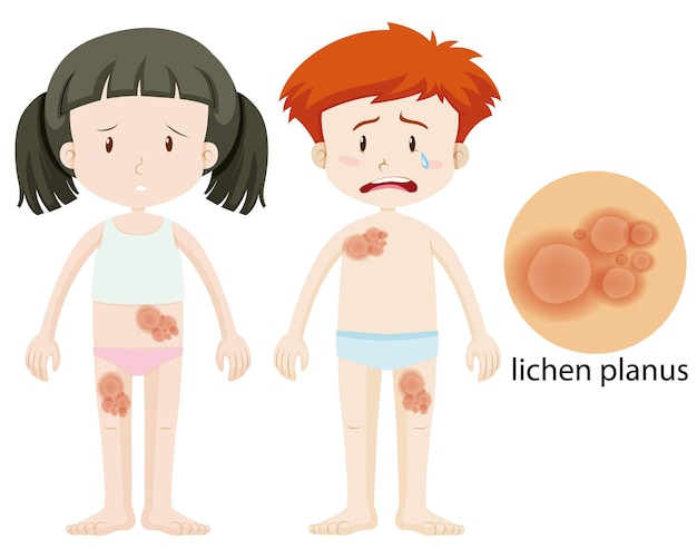 Gratis vector jongen en meisje met lichen planus