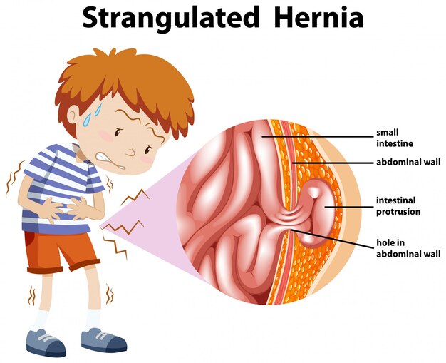 Jongen met gewurgde hernia op diagram