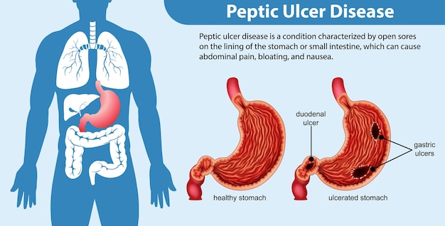 Gratis vector maagzweer ziekte infographic