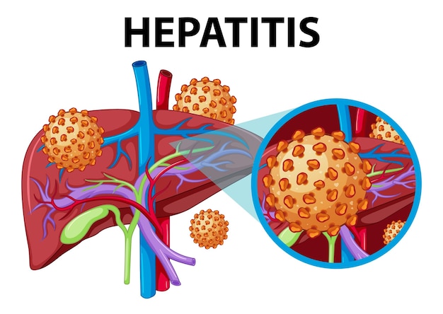 Gratis vector medisch onderwijs humane anatomie van de lever bij hepatitis