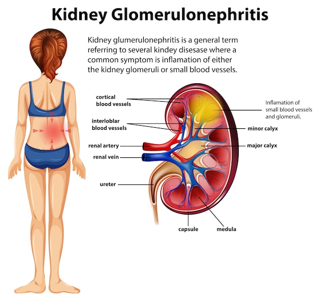 Gratis vector medische infographic van nierglomerulosclerose