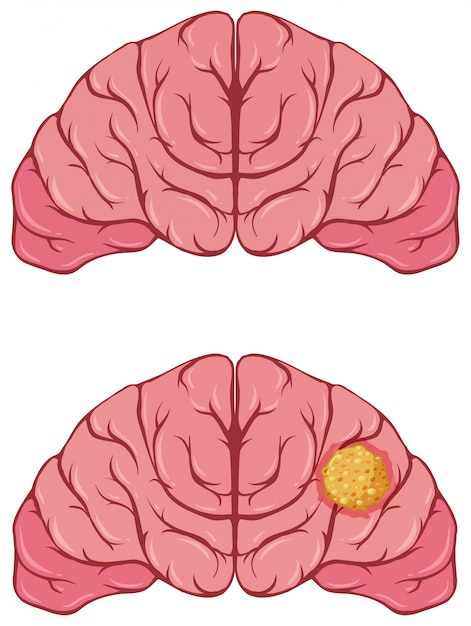 Gratis vector menselijk brein met kanker