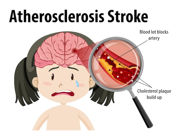 Gratis vector menselijke anatomie met atherosclerose beroerte