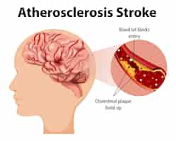 Gratis vector menselijke anatomie met atherosclerose beroerte