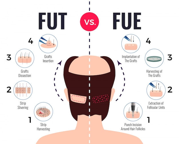 Methoden voor haartransplantatie fut vs fue poster met infographic elementen op wit