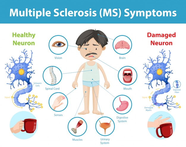 Gratis vector multiple sclerose (ms) symptomen informatie infographic