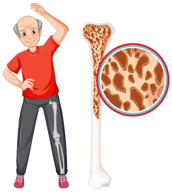 Gratis vector osteoporose bij oude mensen