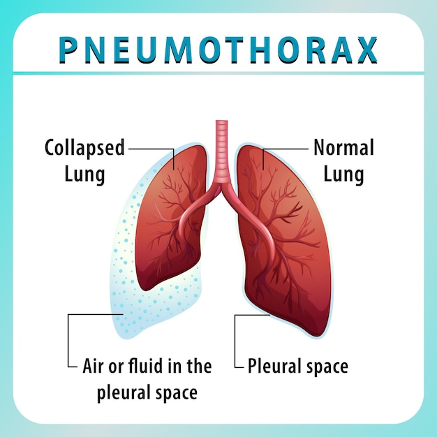 Pneumothoraxdiagram met ingeklapte long en normale long