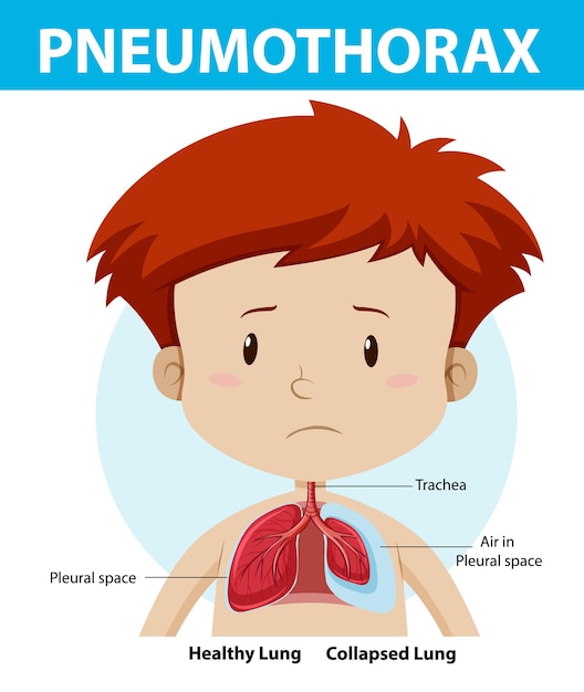 Pneumothoraxdiagram van de menselijke anatomie