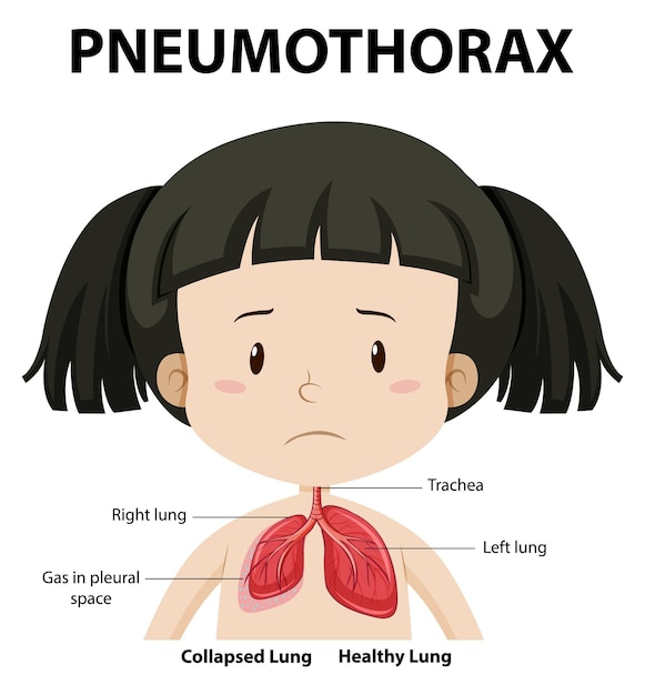 Gratis vector pneumothoraxdiagram van de menselijke anatomie