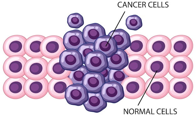Gratis vector proces van de ontwikkeling van kankercellen