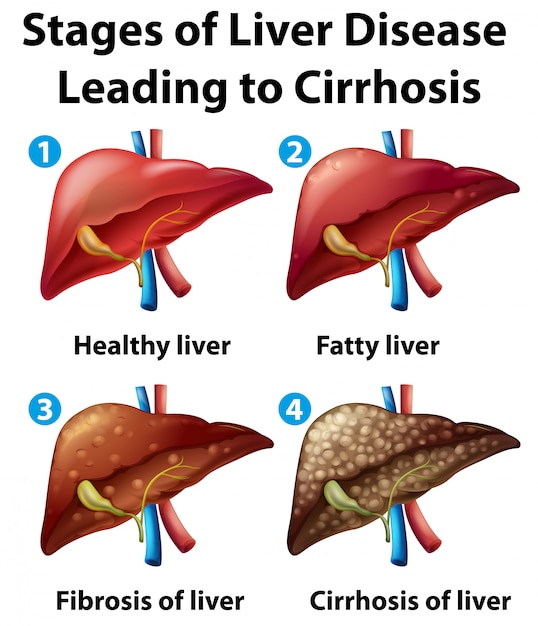 Stadia van leverziekte die leiden tot cirrose