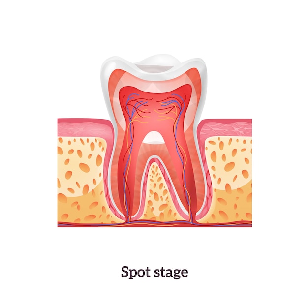 Gratis vector tandanatomie met vlekstadium van cariës