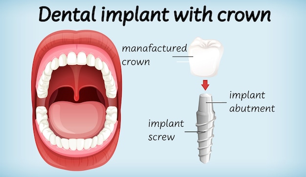 Gratis vector tandheelkundig implantaat met kroon