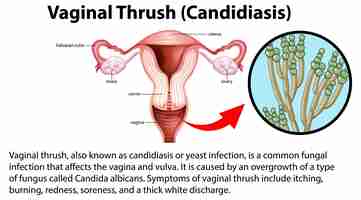 Gratis vector vaginale lijster candidiasis infographic met uitleg