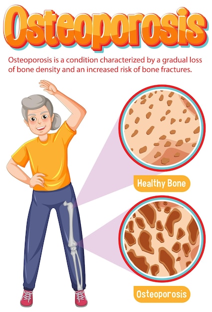 Gratis vector vergelijking van normaal bot en bot met osteoporose bij oude mensen