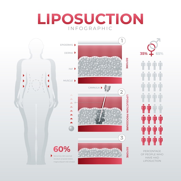 Gratis vector verloop liposuctie infographic